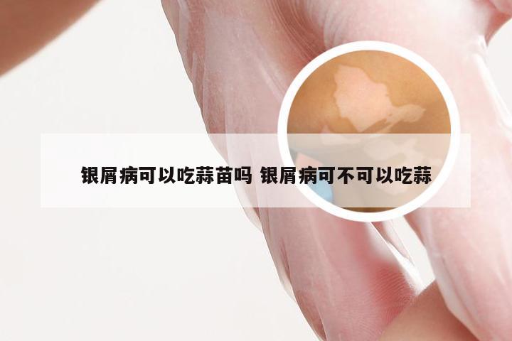 银屑病可以吃蒜苗吗 银屑病可不可以吃蒜