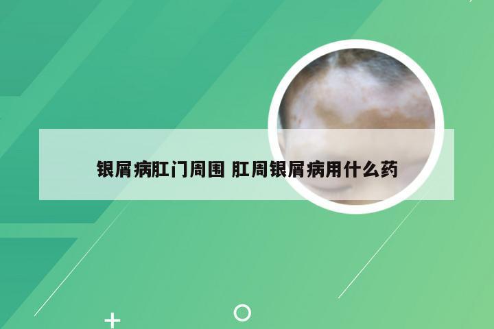 银屑病肛门周围 肛周银屑病用什么药