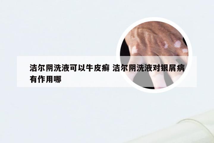 洁尔阴洗液可以牛皮癣 洁尔阴洗液对银屑病有作用哪