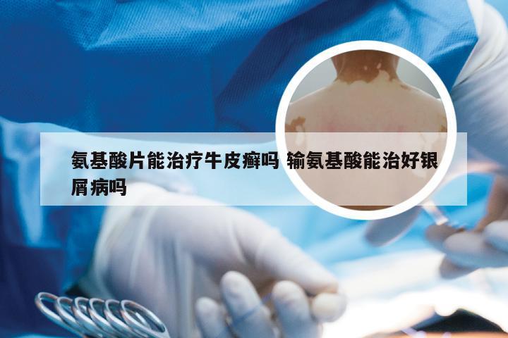 氨基酸片能治疗牛皮癣吗 输氨基酸能治好银屑病吗