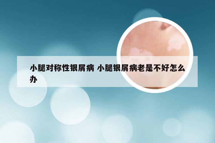 小腿对称性银屑病 小腿银屑病老是不好怎么办