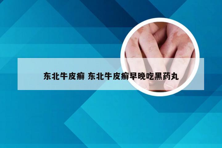 东北牛皮癣 东北牛皮癣早晚吃黑药丸