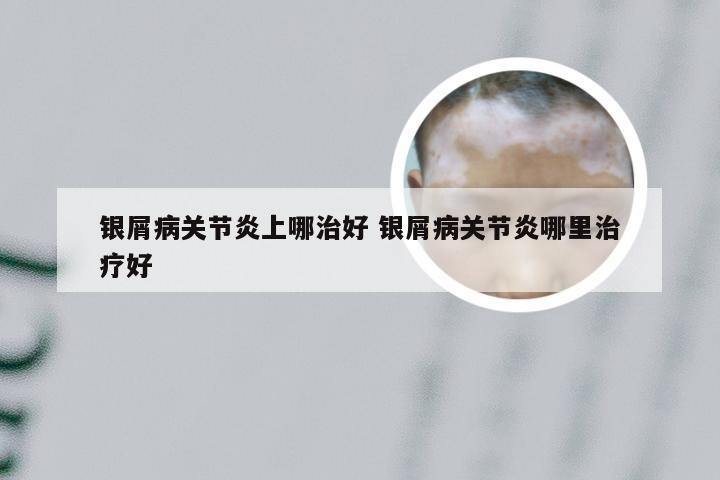 银屑病关节炎上哪治好 银屑病关节炎哪里治疗好
