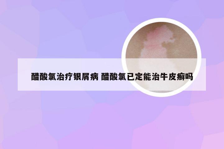 醋酸氯治疗银屑病 醋酸氯已定能治牛皮癣吗