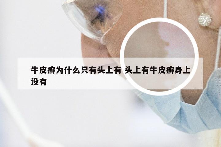 牛皮癣为什么只有头上有 头上有牛皮癣身上没有