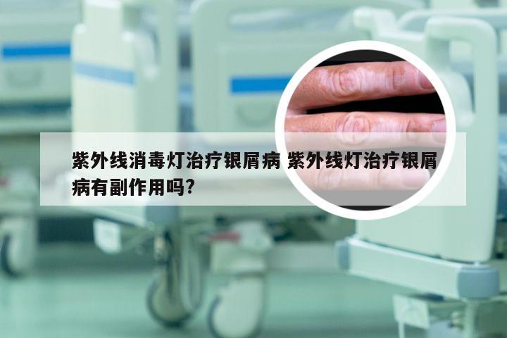 紫外线消毒灯治疗银屑病 紫外线灯治疗银屑病有副作用吗?