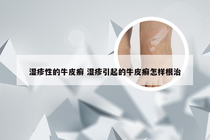 湿疹性的牛皮癣 湿疹引起的牛皮癣怎样根治