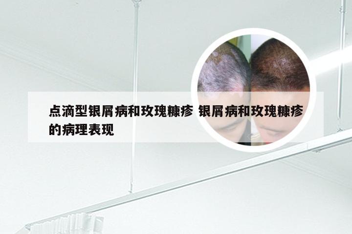 点滴型银屑病和玫瑰糠疹 银屑病和玫瑰糠疹的病理表现