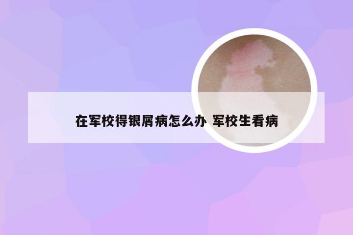 在军校得银屑病怎么办 军校生看病