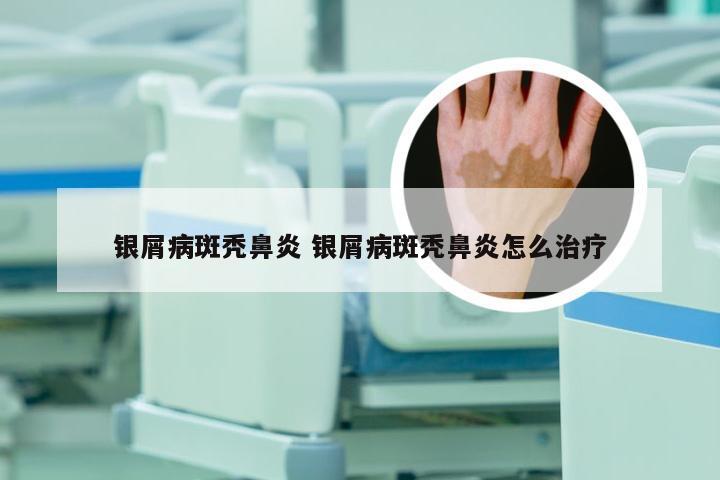 银屑病斑秃鼻炎 银屑病斑秃鼻炎怎么治疗