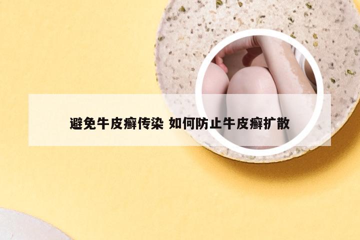 避免牛皮癣传染 如何防止牛皮癣扩散