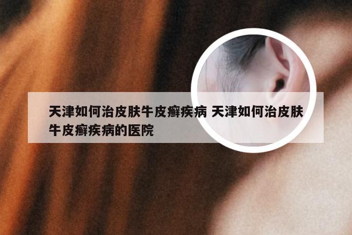 天津如何治皮肤牛皮癣疾病 天津如何治皮肤牛皮癣疾病的医院
