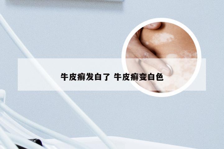 牛皮癣发白了 牛皮癣变白色