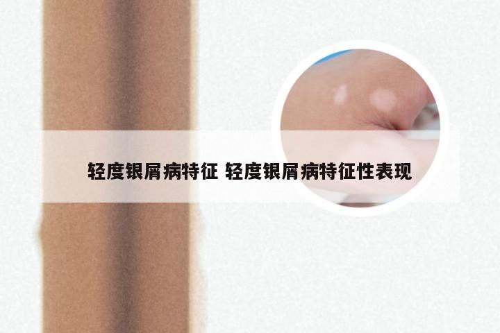 轻度银屑病特征 轻度银屑病特征性表现
