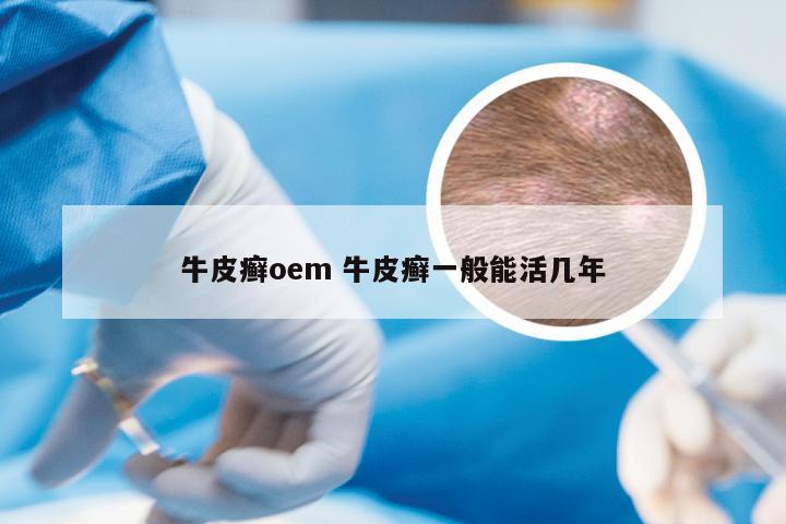 牛皮癣oem 牛皮癣一般能活几年