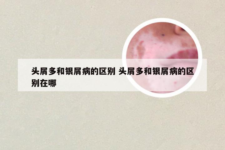 头屑多和银屑病的区别 头屑多和银屑病的区别在哪