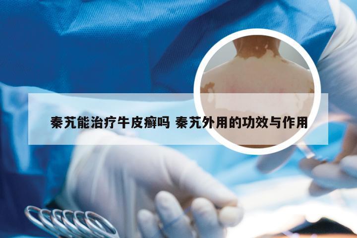 秦艽能治疗牛皮癣吗 秦艽外用的功效与作用