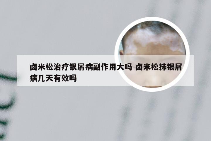 卤米松治疗银屑病副作用大吗 卤米松抹银屑病几天有效吗