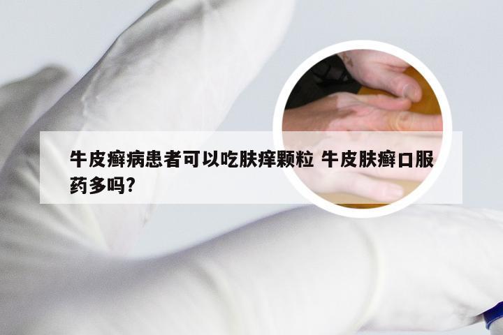 牛皮癣病患者可以吃肤痒颗粒 牛皮肤癣口服药多吗?