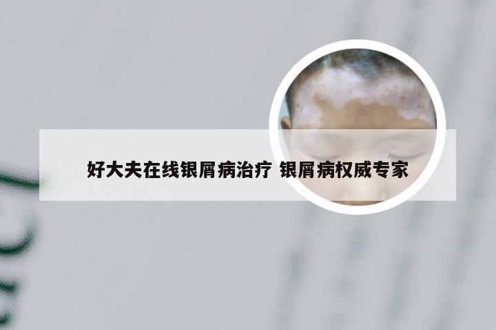 好大夫在线银屑病治疗 银屑病权威专家