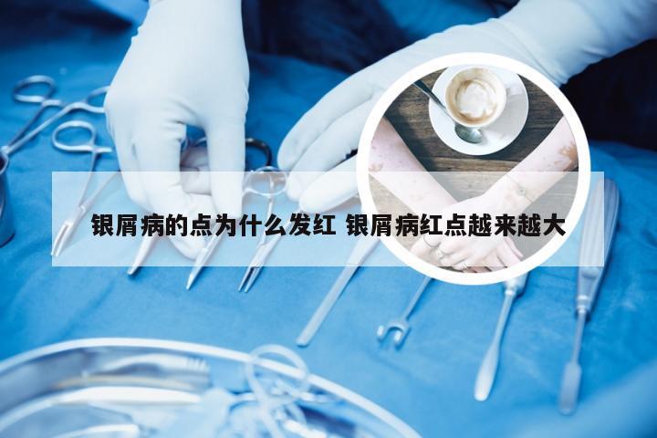 银屑病的点为什么发红 银屑病红点越来越大
