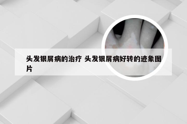 头发银屑病的治疗 头发银屑病好转的迹象图片