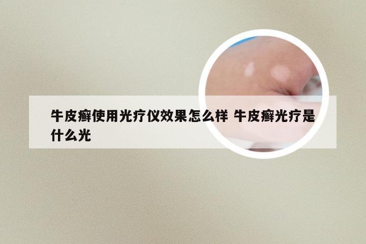 牛皮癣使用光疗仪效果怎么样 牛皮癣光疗是什么光