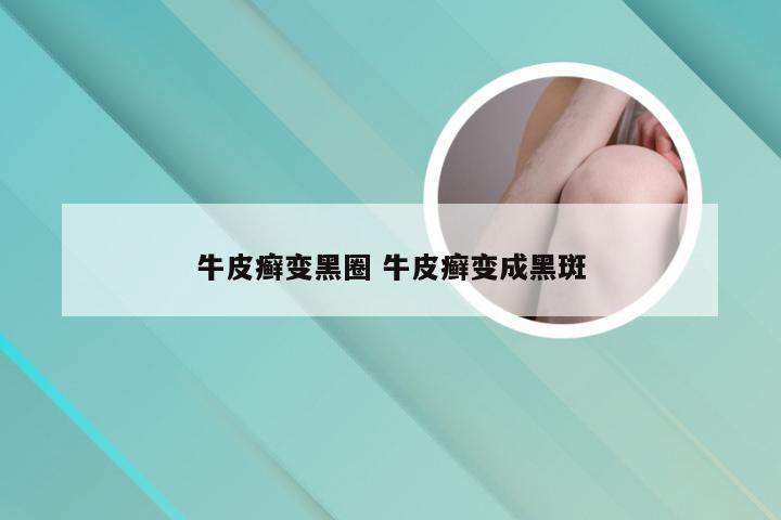 牛皮癣变黑圈 牛皮癣变成黑斑