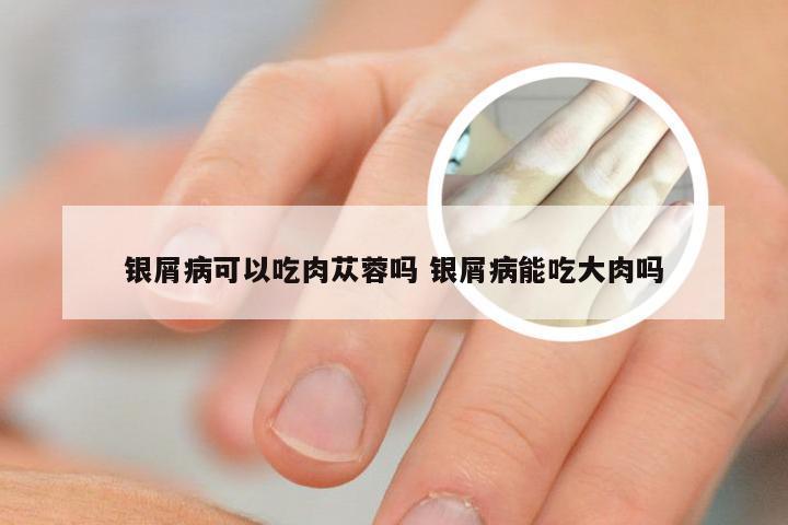 银屑病可以吃肉苁蓉吗 银屑病能吃大肉吗
