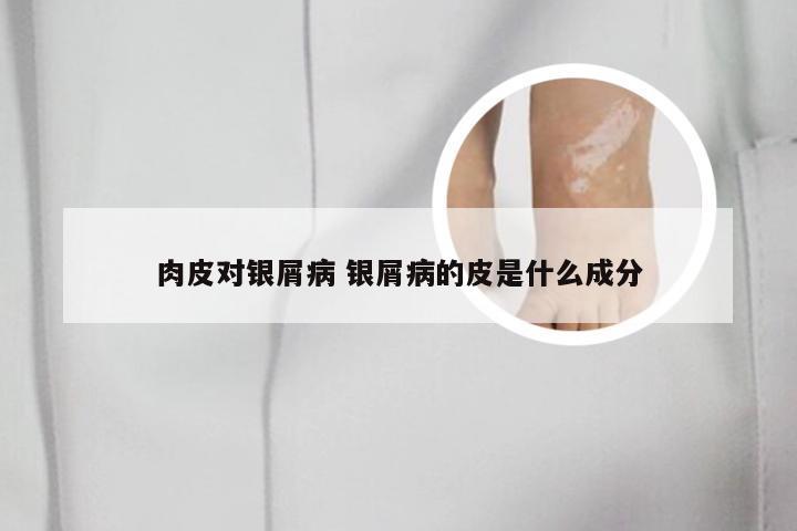 肉皮对银屑病 银屑病的皮是什么成分