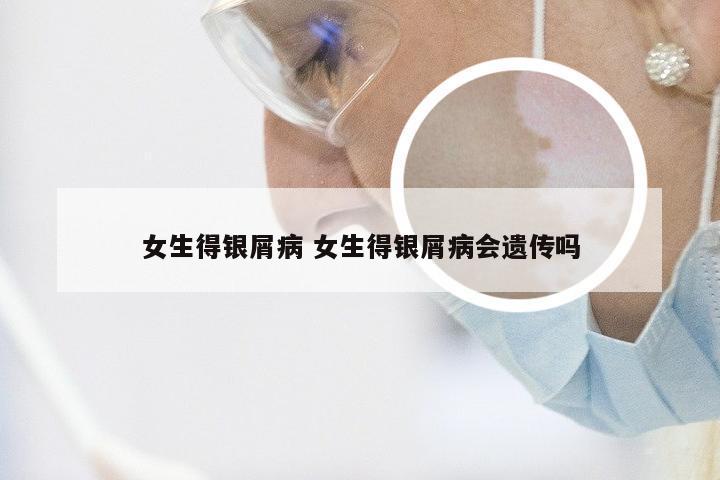 女生得银屑病 女生得银屑病会遗传吗