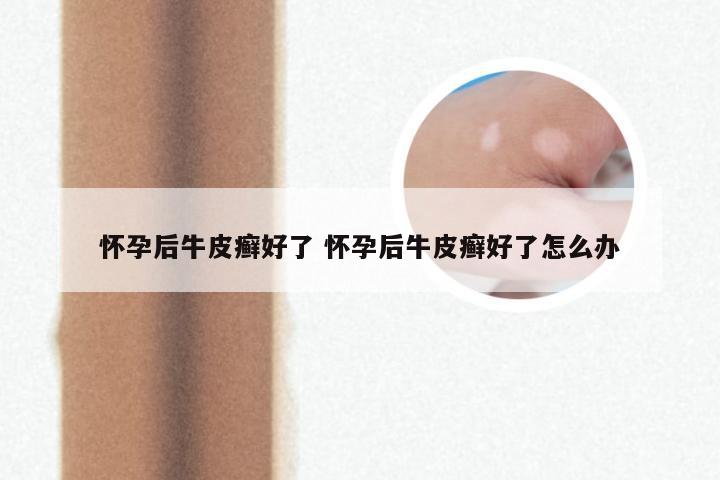 怀孕后牛皮癣好了 怀孕后牛皮癣好了怎么办