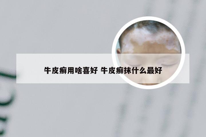 牛皮癣用啥喜好 牛皮癣抹什么最好