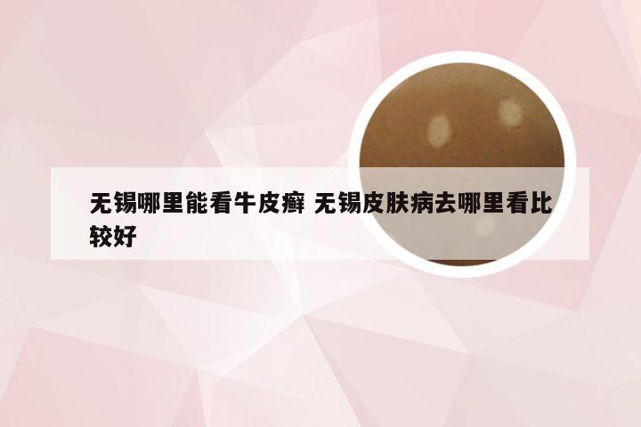 无锡哪里能看牛皮癣 无锡皮肤病去哪里看比较好