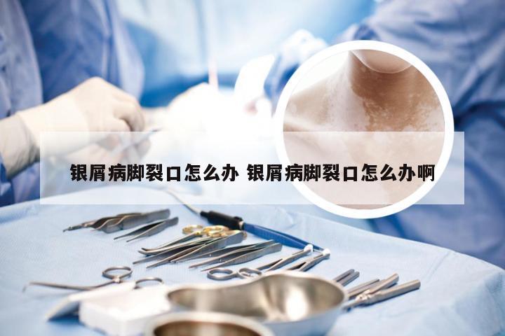 银屑病脚裂口怎么办 银屑病脚裂口怎么办啊