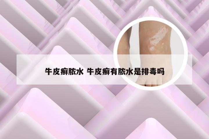 牛皮癣脓水 牛皮癣有脓水是排毒吗
