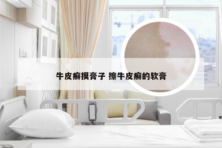 牛皮癣摸膏子 擦牛皮癣的软膏