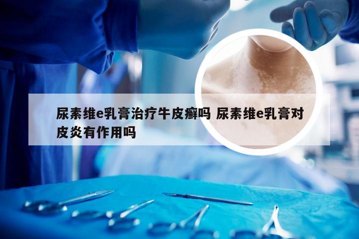 尿素维e乳膏治疗牛皮癣吗 尿素维e乳膏对皮炎有作用吗