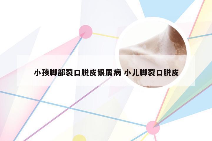 小孩脚部裂口脱皮银屑病 小儿脚裂口脱皮