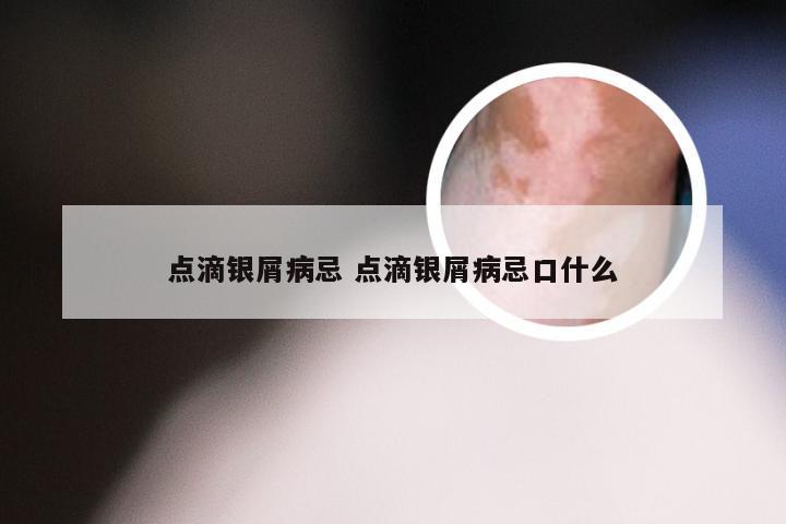 点滴银屑病忌 点滴银屑病忌口什么