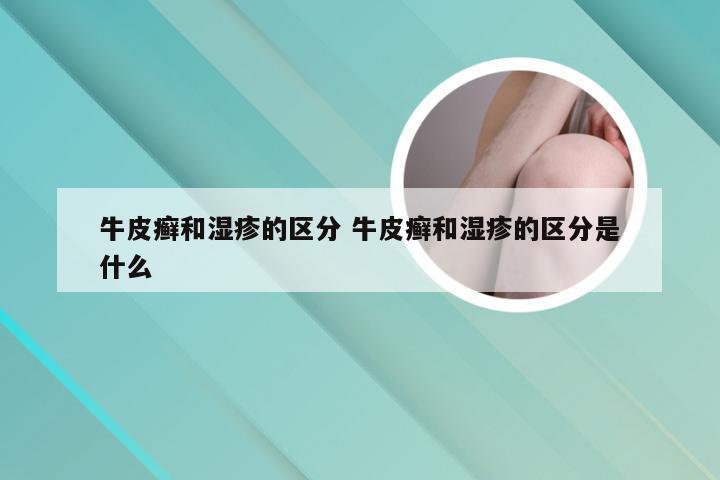 牛皮癣和湿疹的区分 牛皮癣和湿疹的区分是什么
