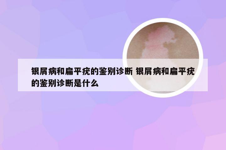 银屑病和扁平疣的鉴别诊断 银屑病和扁平疣的鉴别诊断是什么