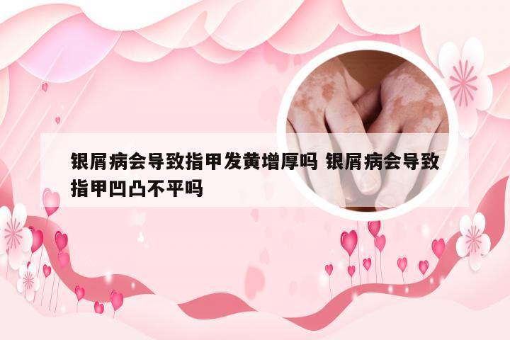 银屑病会导致指甲发黄增厚吗 银屑病会导致指甲凹凸不平吗