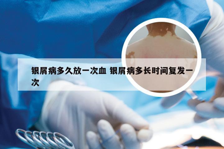 银屑病多久放一次血 银屑病多长时间复发一次