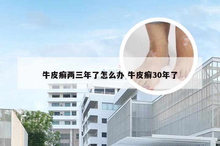 牛皮癣两三年了怎么办 牛皮癣30年了