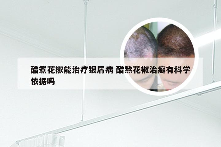 醋煮花椒能治疗银屑病 醋熬花椒治癣有科学依据吗