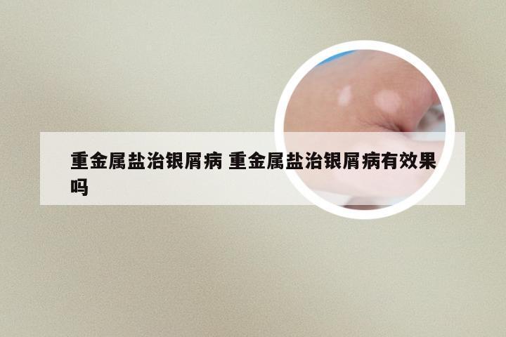 重金属盐治银屑病 重金属盐治银屑病有效果吗