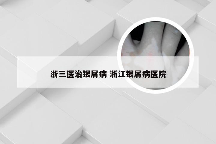 浙三医治银屑病 浙江银屑病医院