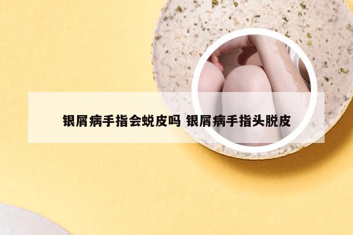 银屑病手指会蜕皮吗 银屑病手指头脱皮