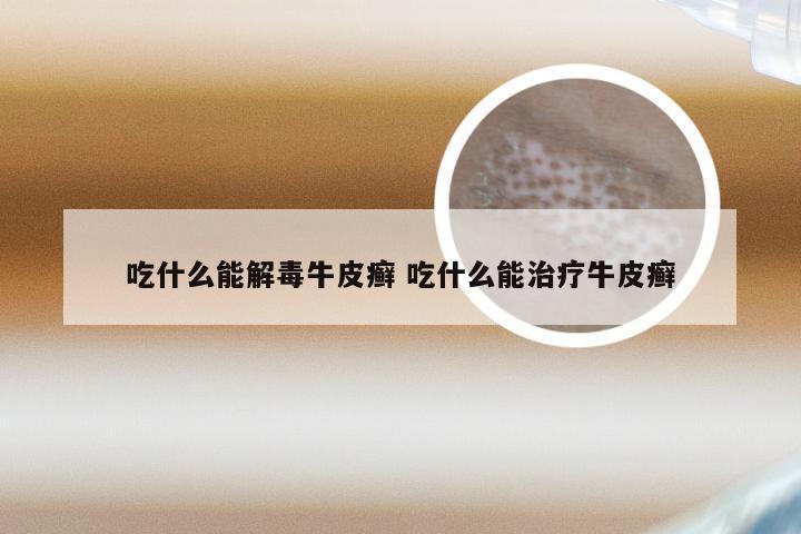 吃什么能解毒牛皮癣 吃什么能治疗牛皮癣